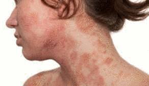 comment soigner plaque d'eczema