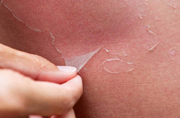 comment soigner la peau qui pele