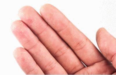 Doigts collés - 6 méthodes pour décoller des doigts - Tout pratique